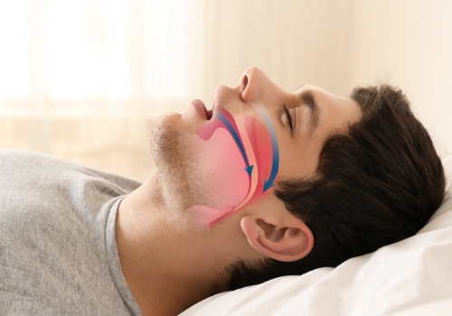 Man sleeping on back with illustration of blocked airway
