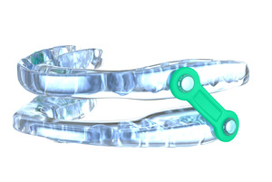 Close-up of an oral appliance for treating sleep apnea